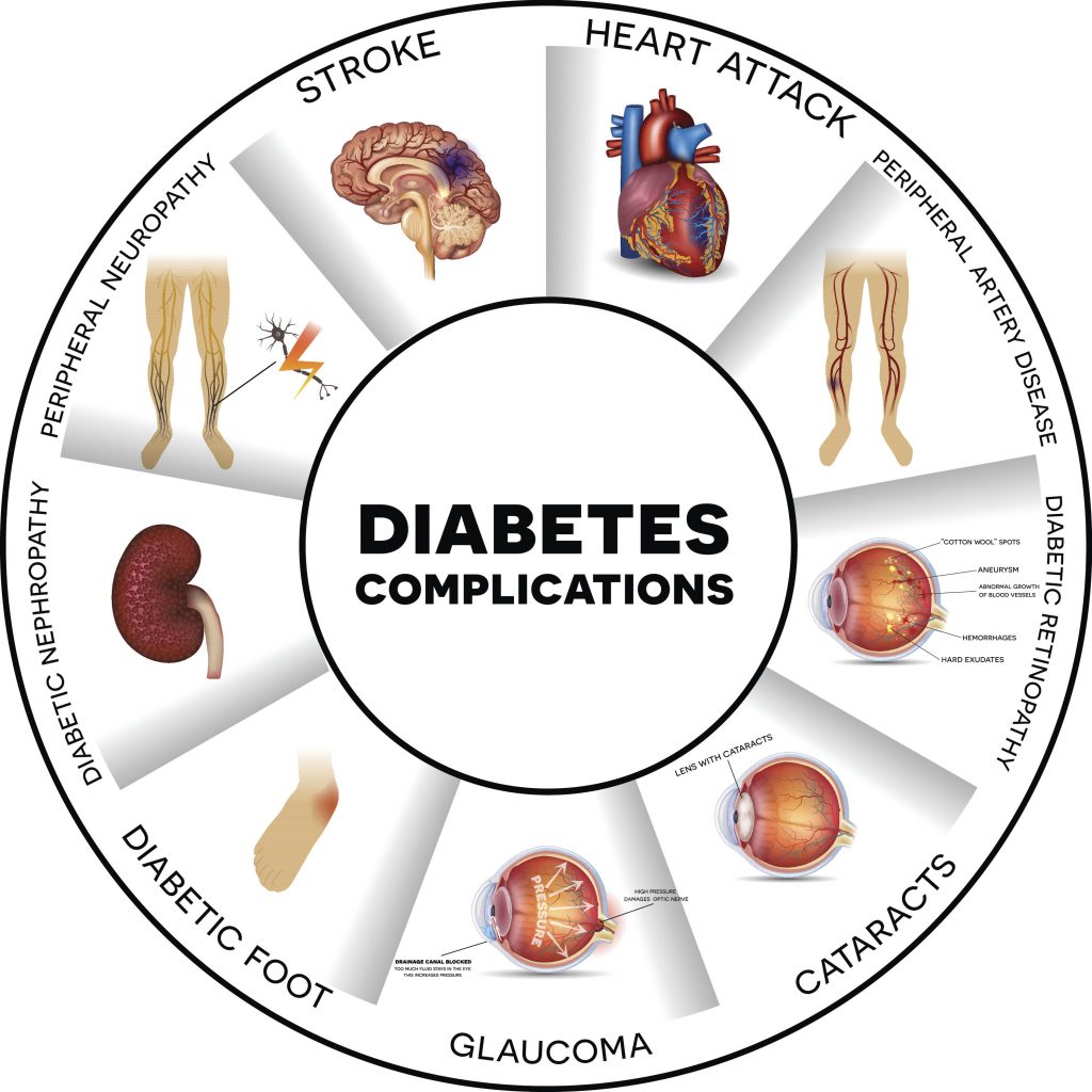 An wheel of illustrations highlighting various diabetes complications, including stroke, cataracts, diabetic foot, and more.